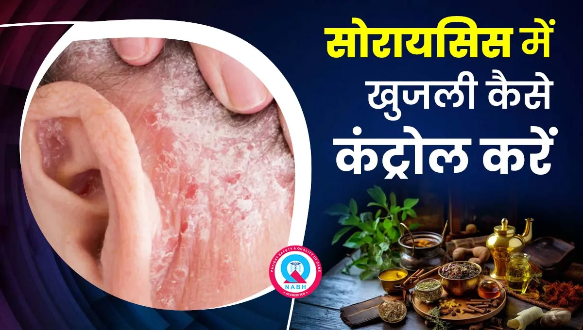 सोरायसिस-में-खुजली-कैसे-कंट्रोल-करें